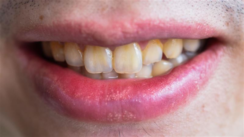 不只咖啡、茶　4類飲品讓你牙齒變黃