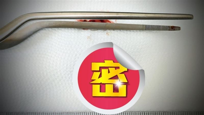 鼻塞10多年…醫見「陳年大鼻屎」挖到流汗