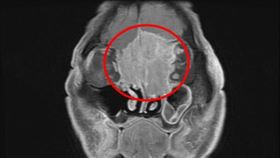 黃先生罹患罕見的「嗅神經母細胞癌」，且腫瘤已長到6公分，從大腦額葉到雙側眼框到鼻腔上部，佔據整個前顱底並侵蝕到鼻樑骨。（圖／慈醫提供）