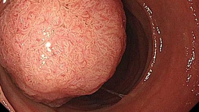 胃痛竟是「5cm壺腹腫瘤」作怪　醫曝3症狀