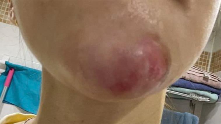 玻尿酸整壞了　她網購解藥自己打腫成河馬