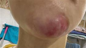 1106黃毓惠醫師提供