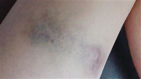 李婉鈺 瘀青照 本人提供