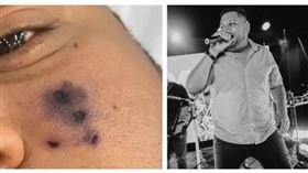 28歲男歌手被蜘蛛咬「臉發黑」…6天後死亡　女兒也送醫