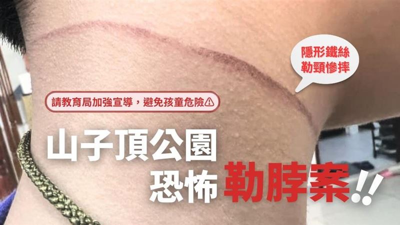 男童公園遭「隱形鐵絲」勒喉　險割頸動脈