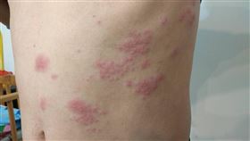 壓力,紅疹,抽痛,皮膚病,衛福部彰化醫院,莊佳慧,帶狀皰疹,皮蛇