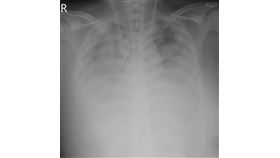  33歲女OL，得Ａ流罕見兩肺全白，併發重症，嚴重缺氧，裝置葉克膜10天搶命救回(圖／烏日林新醫院提供)
