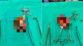 患者左面部約10年前出現一處「指甲蓋」大小的黑點，逐漸惡化為腫瘤。（圖／翻攝自極目新聞）