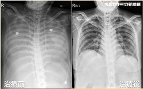 女肚痛住院照X光　醫驚：肺臟竟都消失了（圖／翻攝畫面）