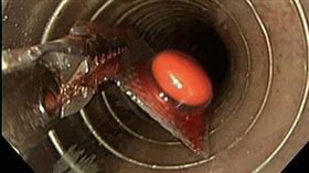 嬤吃藥「誤吞鋁片」痛爆　醫：本月第3起（圖／翻攝自錢政弘 胃腸肝膽科醫師臉書）