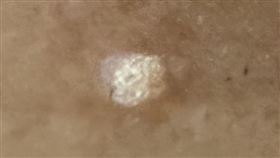 臉部病毒疣(書田診所)