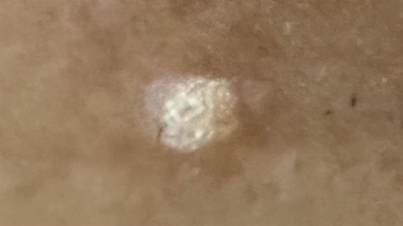 臉頰冒「白色怪東西」　竟是菜花同類病毒