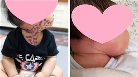 陽光基金會,微血管畸形,雷射(陽光基金會 提供)