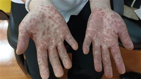 27歲的蕭小姐近日雙手及雙腳突布滿密密麻麻的紅疹，看來怵目驚心。（圖／彰化醫院提供）