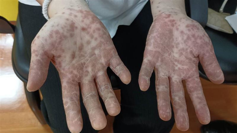 慎入！以為感冒　辣媽冒百顆紅疹猶如喪屍