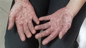 2寶媽全身起百顆水泡！手腳還冒大片紅疹　兒科醫：腸病毒仍在大流行