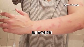 獨／臭蟲肉眼可見　不幸遭咬紅腫搔癢難受