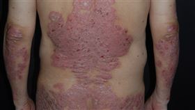 乾癬(國泰醫院提供)