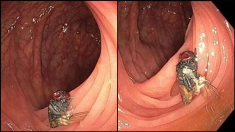男照大腸鏡驚見完整蒼蠅躺腹　恐怖畫面曝