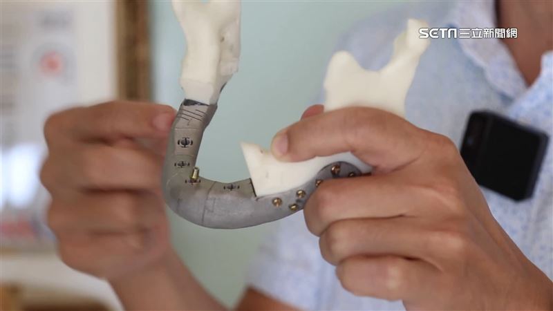 3D列印口顎彌補物　助患者重拾自信