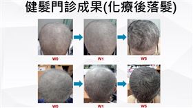 1123中醫治療禿髮(記者黃仲丘)攝影