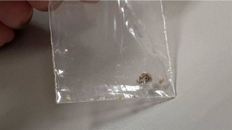 5旬婦小便痠痛　灌水竟尿出0.5公分結石