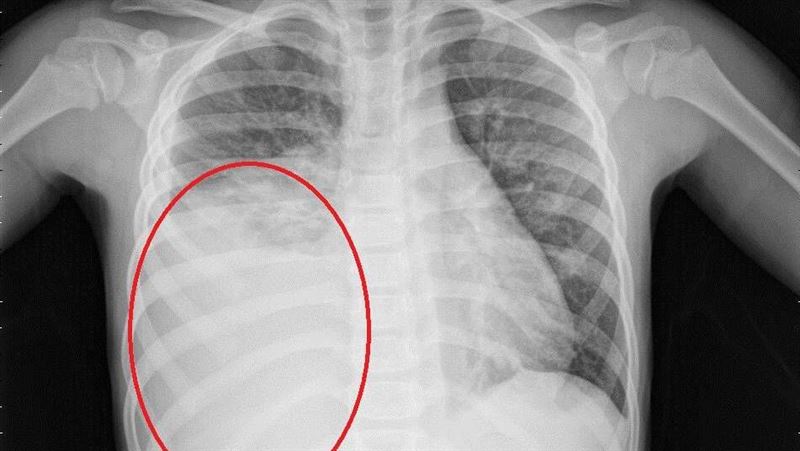 往返中國小心！「大白肺」激增　2招防堵