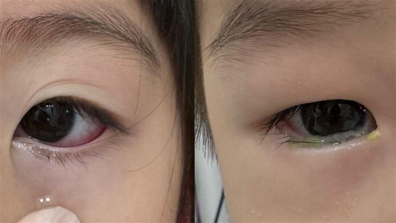 兒童染「燒久姬」病例升！有6症狀要注意