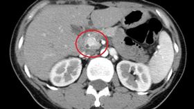 胰島素瘤（亞大醫院提供）