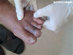 老翁「天冷走路就痛」醫：這邊全塞住了（圖／翻攝畫面）