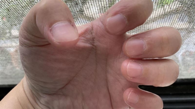 指甲驚見「2特徵」身體出問題？醫師闢謠