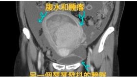 6旬婦頻尿2週誤以為膀胱發炎，醫師揪15公分巨大卵巢癌。（圖翻攝自熱血暖男 戴定恩醫師｜台北 文山 新店 泌尿科 疝氣 結石 攝護腺專業粉絲頁）