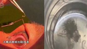 大陸昆明一名女子，日前揉眼睛時，竟有一條蟲從眼睛裡面掉出來，嚇得她急忙前往醫院就診，最終在雙眼取出共60多條寄生蟲。（圖／翻攝自微博）