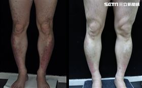 科技男乾癬忍20年，治療對照圖。（圖／記者簡浩正攝影）