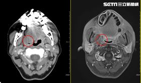 男子脖子右側突然疼痛以為單純喉嚨痛，檢查竟是扁桃腺癌。（圖／中港澄清醫院提供）