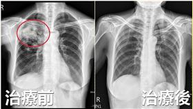 疲倦無力+喘不過氣　台中女肺部被「啃出1個洞」，隱球菌感染，肺炎(圖／亞大醫院提供)