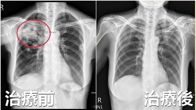 台中女狂喘咳疲倦無力　肺部遭細菌啃破洞