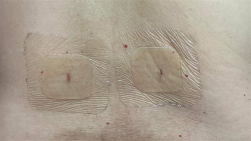 骨水泥救骨折! 長庚團隊找到黃金比例