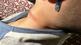 勒痕,拔河,繩子,桃園（圖／翻攝自《爆料公社二社》）