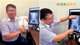 黃煒軒醫師說明，管徑7.5Fr Mini 軟式輸尿管內視鏡進入位置為尿道，由人體天生擁有的天然管道進入、進行治療，不需額外製造新傷口。