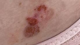 鱗狀細胞癌(台北市立聯合醫院提供)