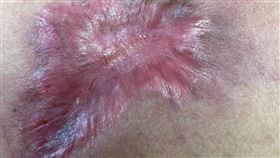 蔡女士折騰3個月才傷口收合。（圖／翻攝自衛生福利部彰化醫院粉專）