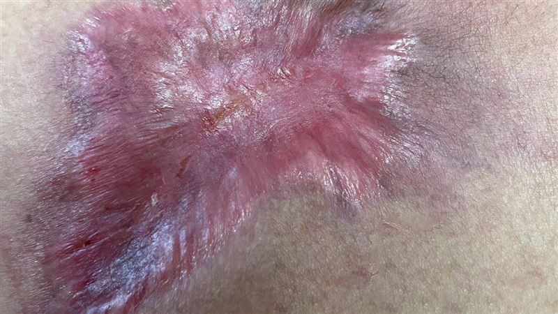 長疔子自擠膿敷草藥 婦傷口潰爛比手機大