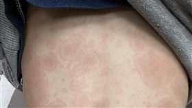 童染「黴漿菌」狂長紅斑！兒科醫曝3前驅症狀　揭「驚悚病程」