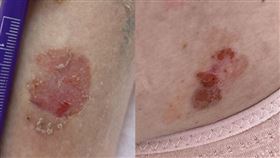 1210鄰狀基底細胞癌