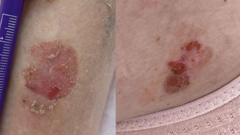 皮膚紅色脫屑不癢不痛 竟罹患鱗狀細胞癌