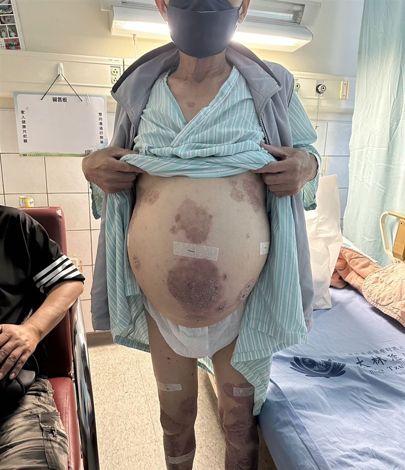 65歲受贈者因肝硬化肚子裡累積大量腹水，外表彷彿婦女懷胎十月。（圖／大林慈濟醫院提供）