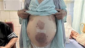 他不是孕婦！肝癌男挺巨肚　器捐助重生(大林慈濟醫院)