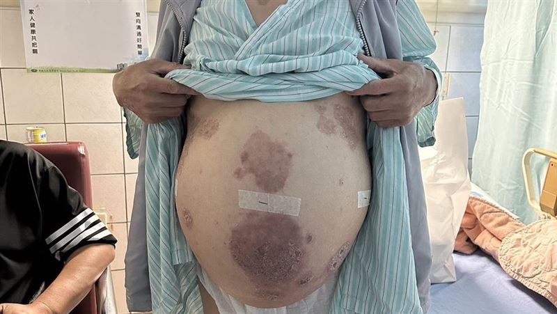 不是孕婦！肝癌男「腹水滿肚」　重生契機來自1位死去的外國人