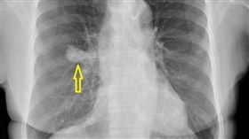 胸部X光/肺癌(安南醫院提供)